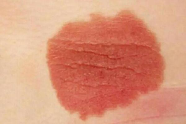 全面解析：胎记算命图解
