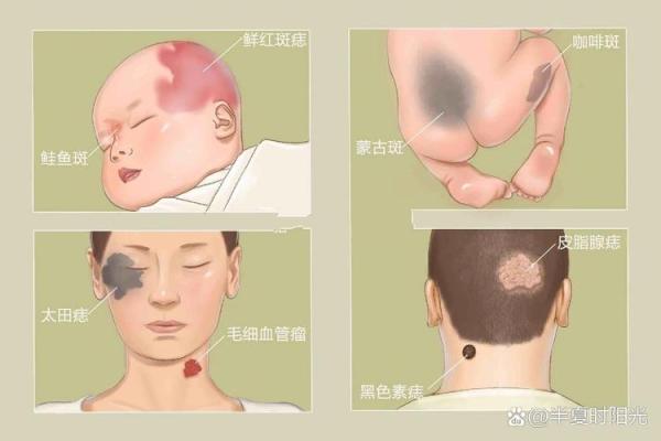 如何根据背部胎记算命-