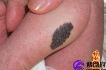 背部胎记算命图解