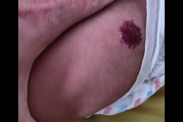 腿上有胎记算命分析