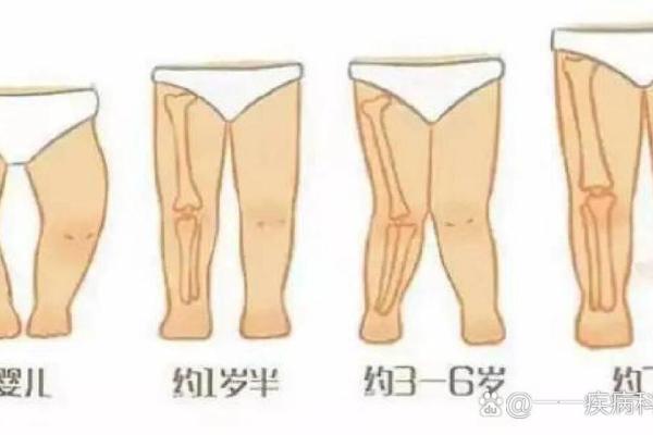 什么是内八字