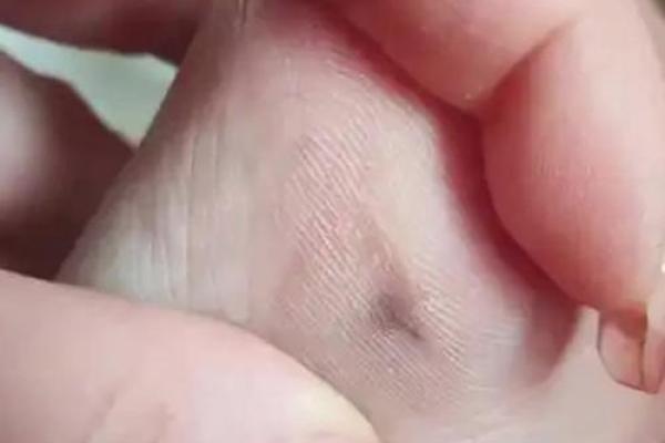 男人脚痣相算命图解