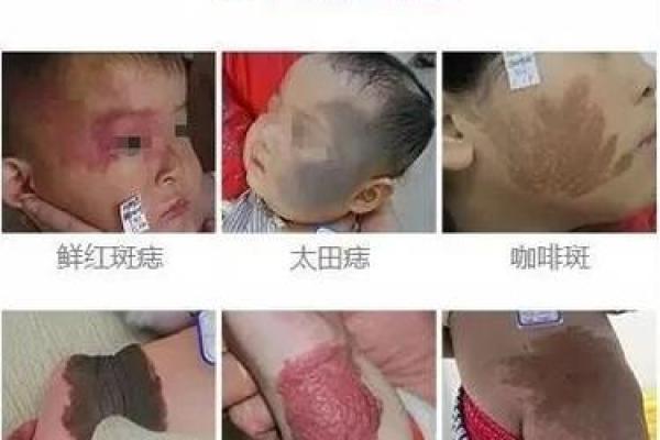 白色胎记算命分析
