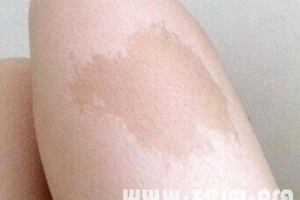 脖子上不同位置胎记算命